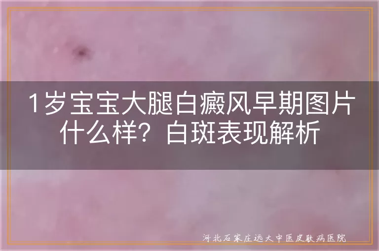 1岁宝宝大腿白癜风早期图片什么样？白斑表现解析