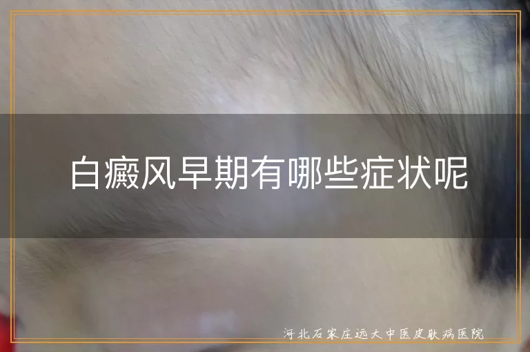 白癜风早期有哪些症状呢