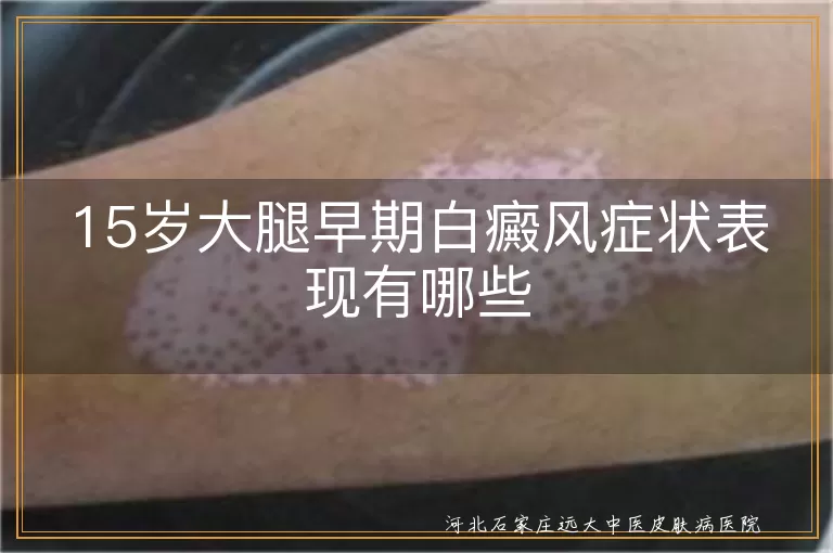 15岁大腿白癜风早期症状表现,青少年大腿白斑早期是什么样,大腿早期白癜风白斑特点有哪些