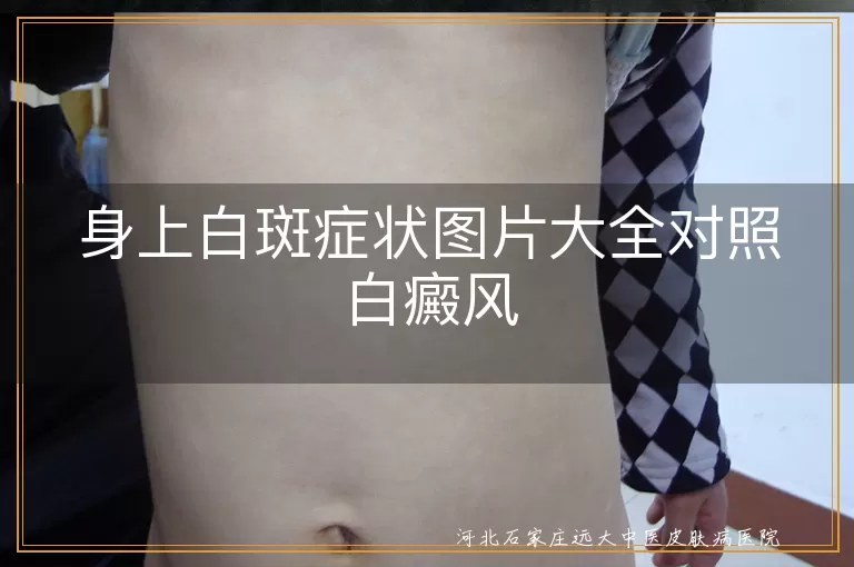 身上有白斑是白癜风图片症状,白斑和白癜风的症状图片大全对比,身上长白斑怎么回事图片对照白癜风