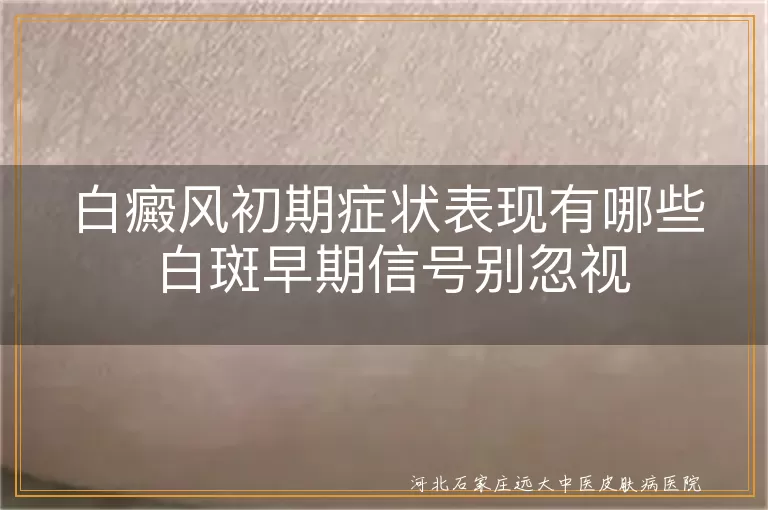 白癜风初期症状表现有哪些 白斑早期信号别忽视