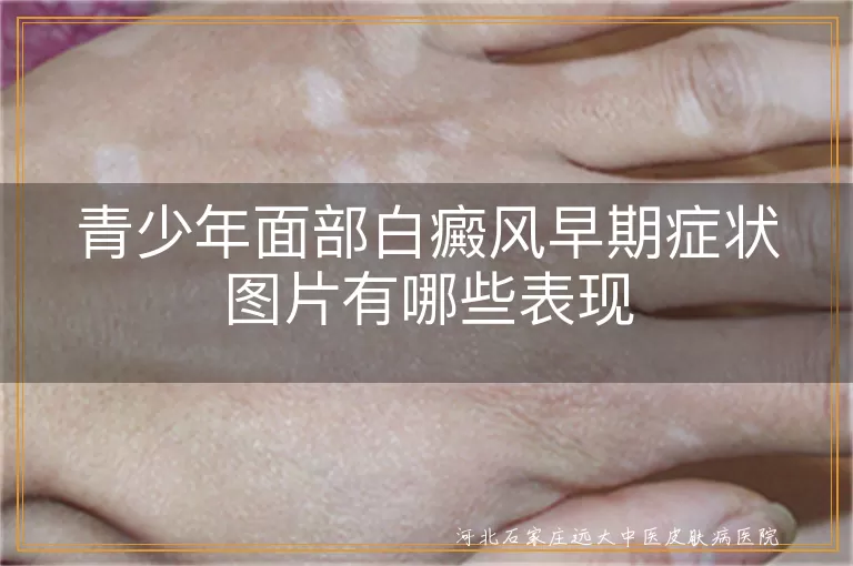 青少年面部白斑早期图片有哪些症状,青少年白癜风面部早期症状图片表现,面部青少年白斑早期症状图片什么样