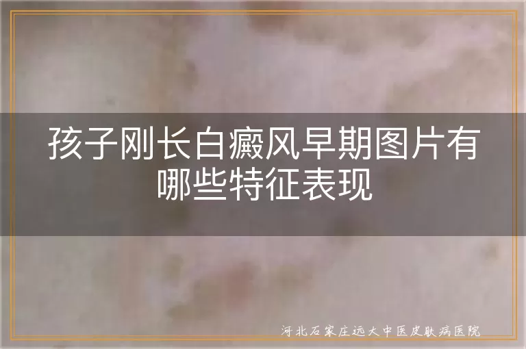 孩子早期白癜风图片特征,儿童白斑初期症状图片,小孩脸上长白斑图片大全