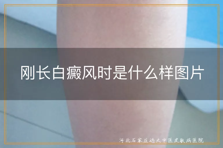 刚长白癜风时是什么样图片