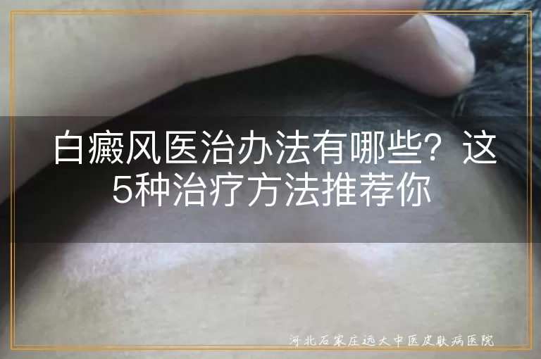 白癜风治疗,如何治疗白癜风,治疗白癜风方法