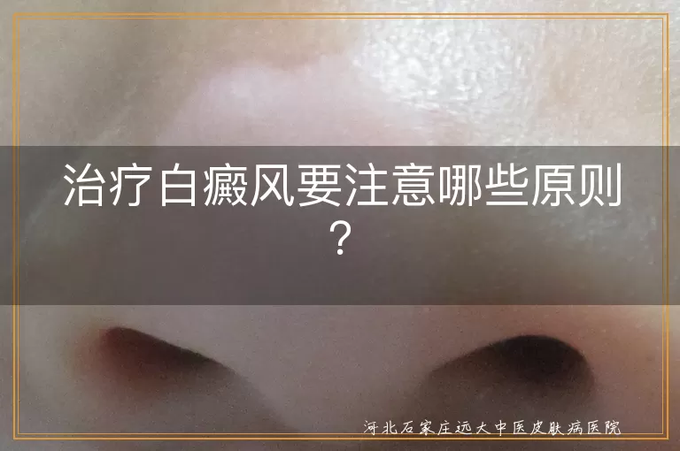 治疗白癜风要注意哪些原则？