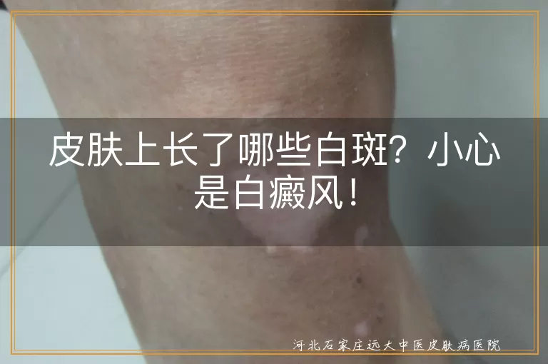 皮肤上长了哪些白斑？小心是白癜风！