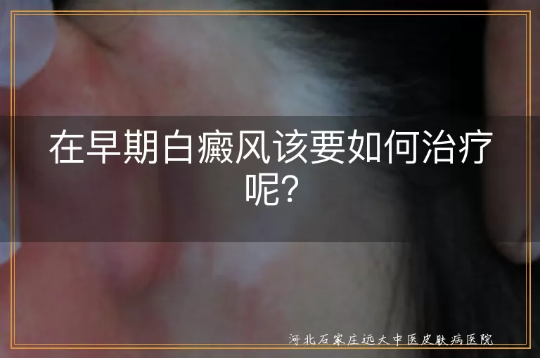 在早期白癜风该要如何治疗呢？