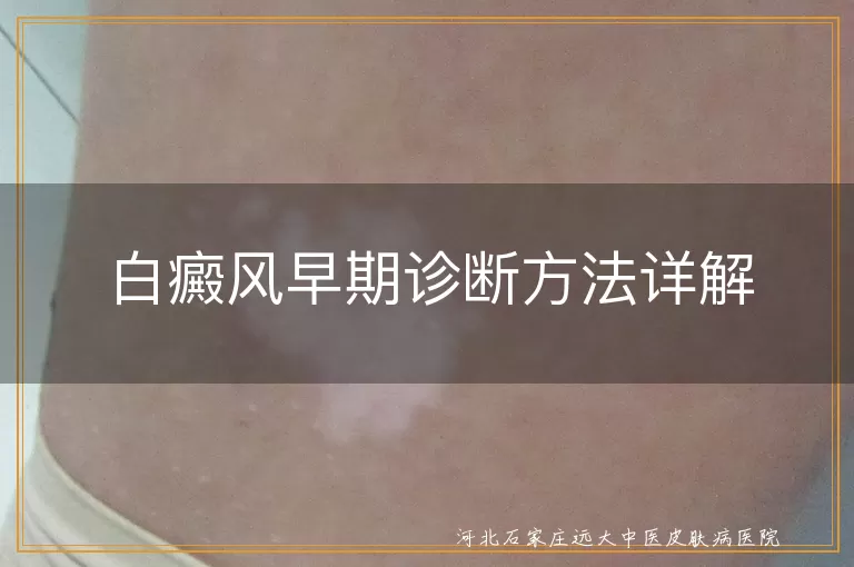 白癜风早期诊断方法详解