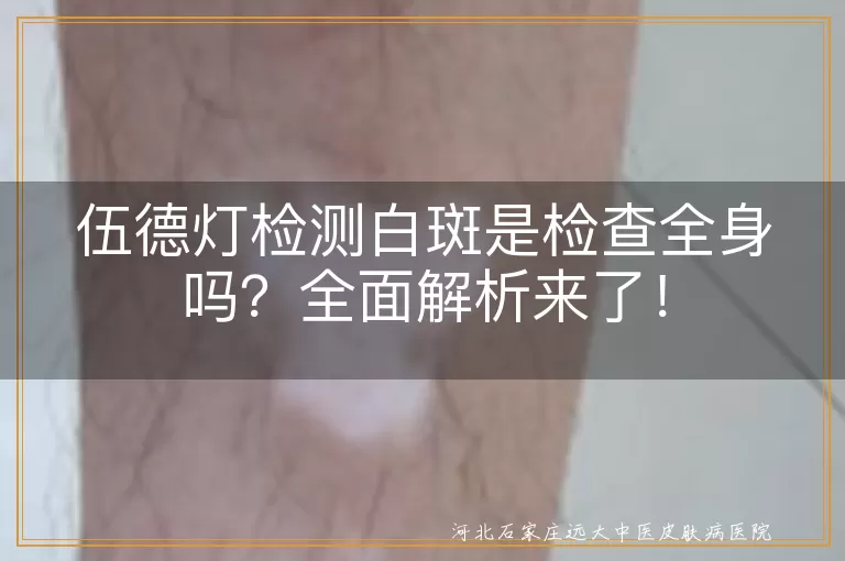 伍德灯检测白斑是检查全身吗？全面解析来了！