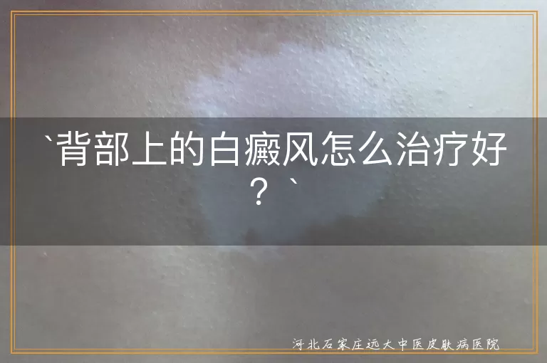 背部上的白癜风怎么治疗好？