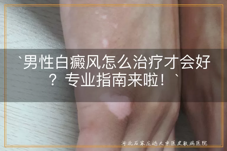 男性白癜风怎么治疗才会好？专业指南来啦！