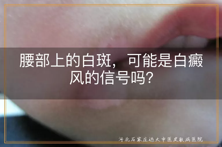 腰部上的白斑，可能是白癜风的信号吗？