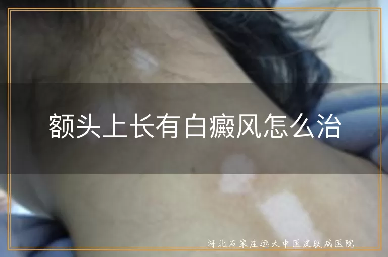 白癜风,额头,治疗方法,生活习惯,药物治疗,光疗,手术治疗,中医治疗