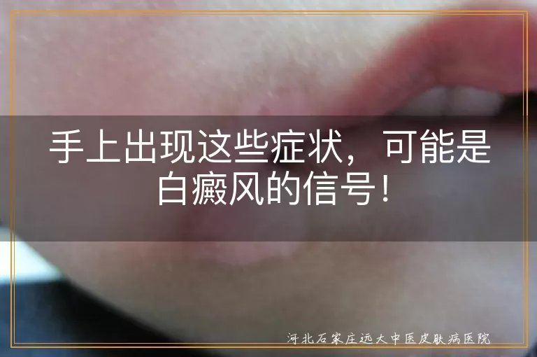 白癜风,手部症状,白斑,皮肤变化,感觉异常,及时就医