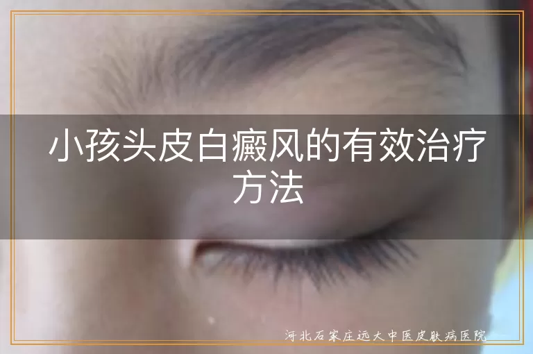 小孩头皮白癜风,治疗方法,药物治疗,物理治疗,手术治疗,心理治疗,日常护理,预防