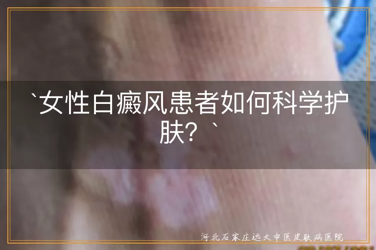 女性白癜风患者如何科学护肤？
