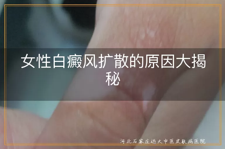 女性白癜风扩散的原因大揭秘
