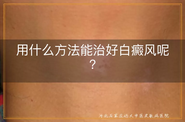 白癜风,治疗方法,药物治疗,光疗,激光治疗,手术治疗,生活方式调整,新疗法,心态调整