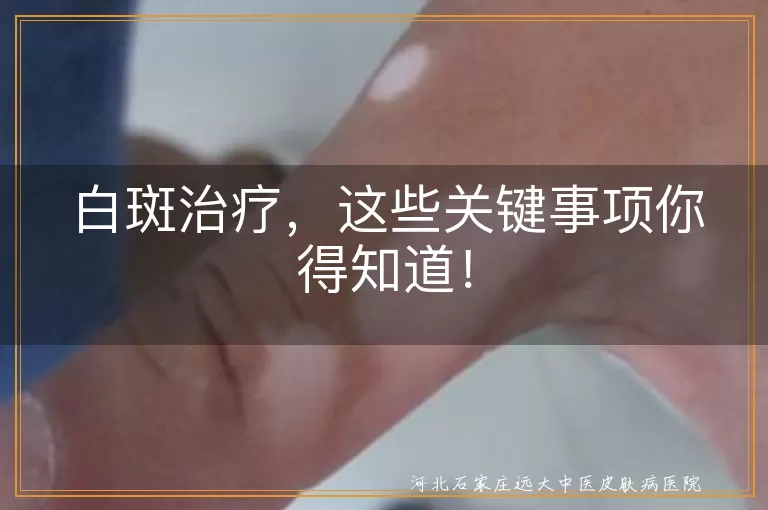 白斑治疗,专业诊断,个性化治疗,耐心坚持,生活习惯,心态调整