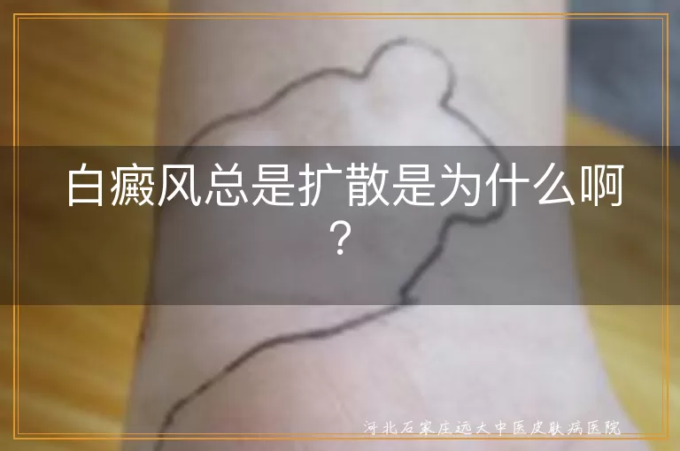 白癜风,扩散,免疫力,精神压力,防护,科学治疗