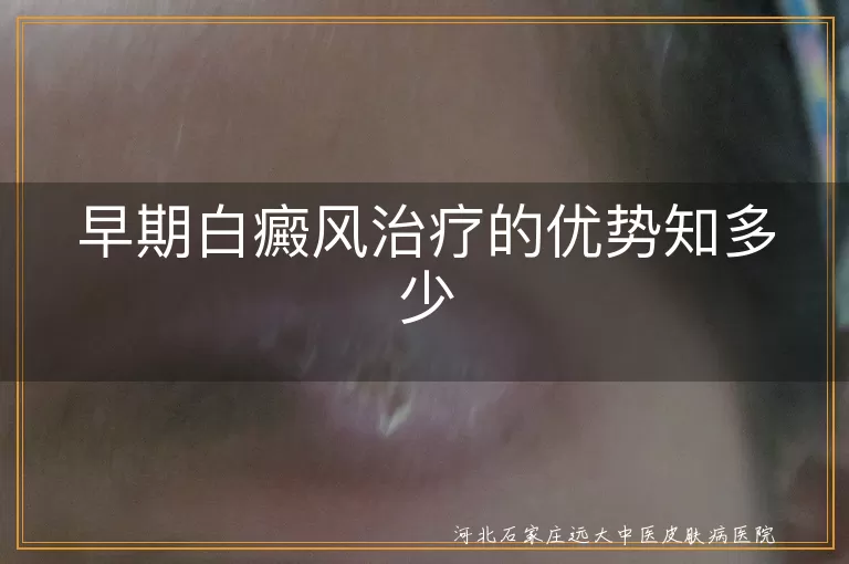 早期白癜风治疗的优势知多少