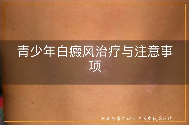 青少年白癜风治疗与注意事项
