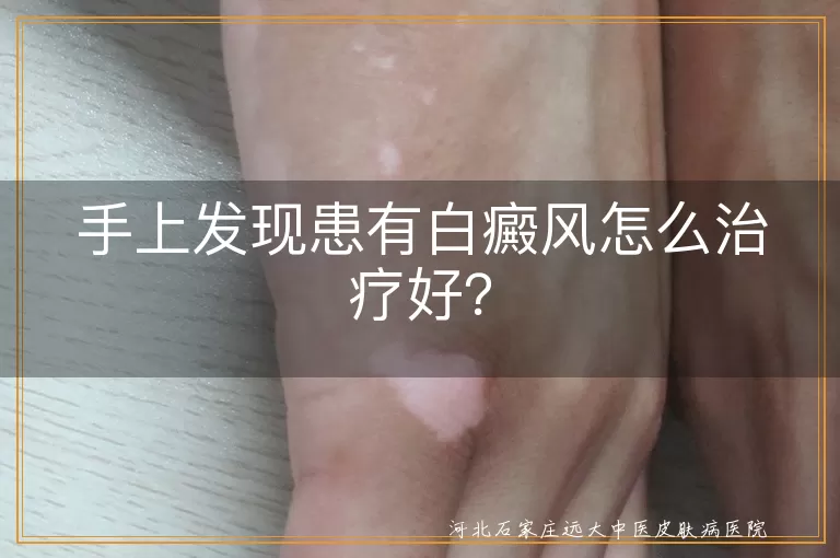 白癜风,治疗,药物治疗,光疗,激光治疗,手术治疗,防晒,饮食调理,心态调整,正规医院