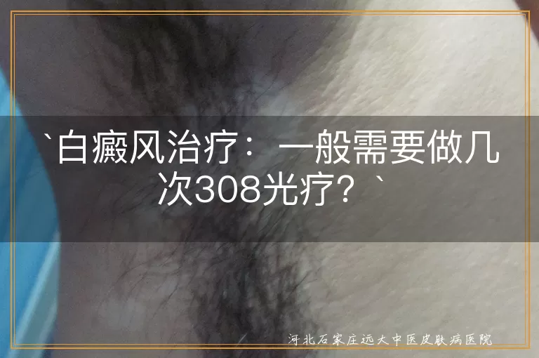 白癜风,308光疗,治疗次数,个体差异,医生沟通,规律治疗,心态,生活习惯