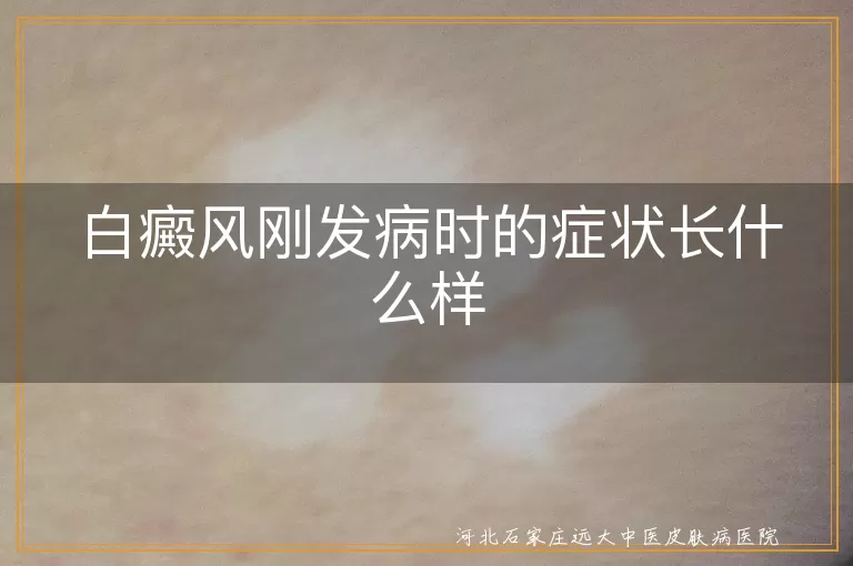 白癜风刚发病时的症状长什么样