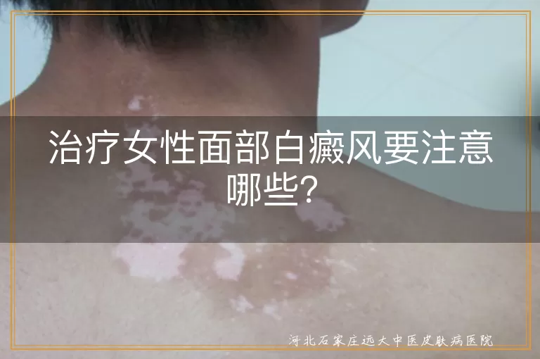 治疗女性面部白癜风要注意哪些？