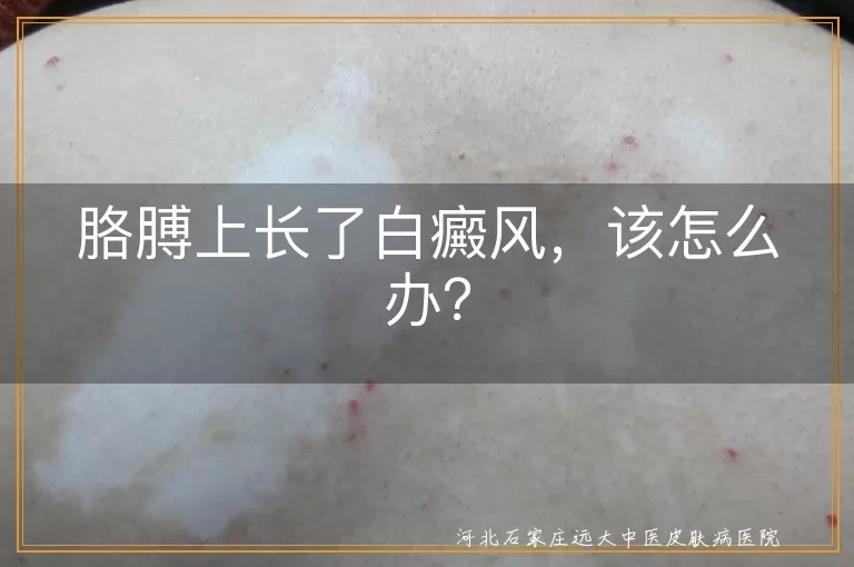 胳膊上长了白癜风，该怎么办？