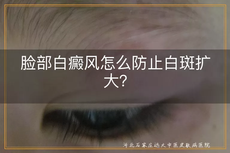 脸部白癜风怎么防止白斑扩大？