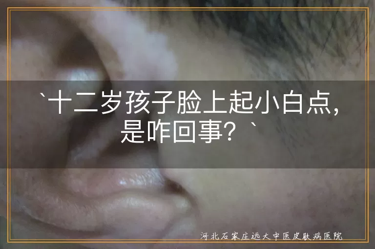 `十二岁孩子`,`脸上小白点`,`青春痘`,`脂肪粒`,`白色糠疹`,`过敏反应`,`皮肤清洁`,`饮食习惯`,`防晒`,`专业帮助`