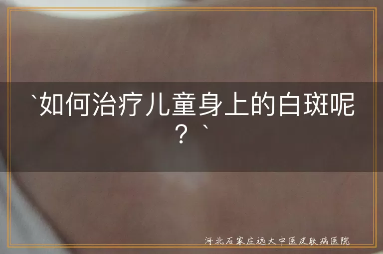如何治疗儿童身上的白斑呢？