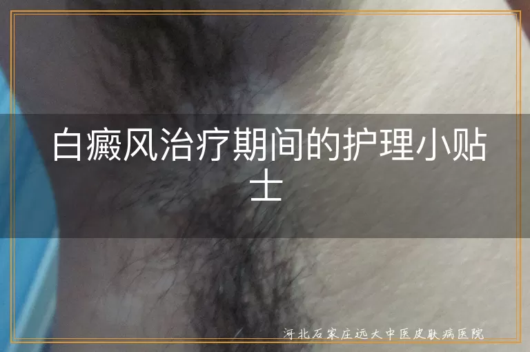 白癜风治疗期间的护理小贴士