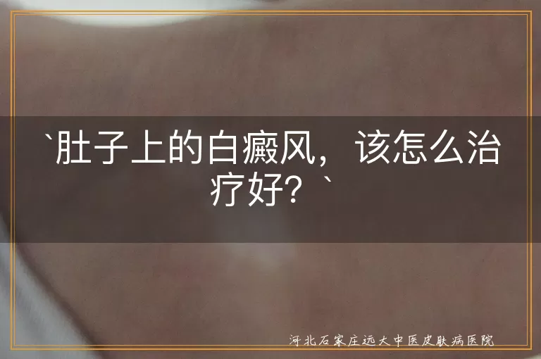 白癜风,肚子,治疗,药物,光疗,手术,心理治疗,防晒,饮食,心态