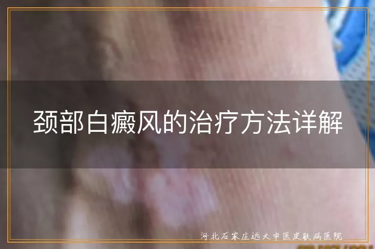 颈部白癜风,治疗方法,药物治疗,物理治疗,手术治疗,中医治疗,预防复发