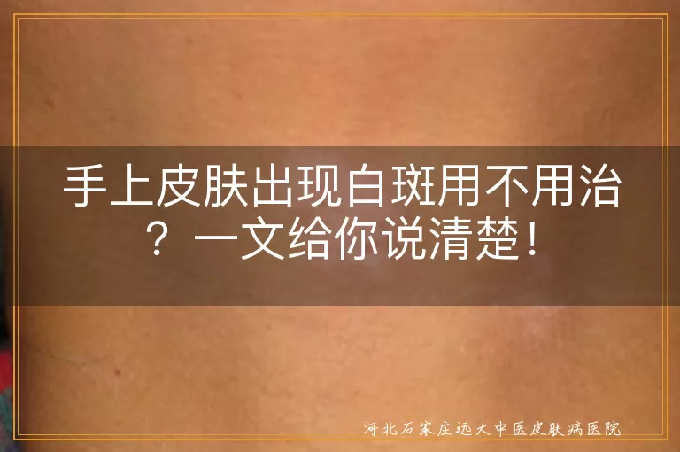 手上白斑,皮肤反应,疾病信号,及时就医,治疗,预防,保护皮肤