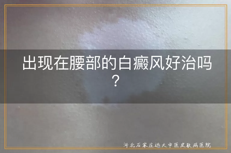 出现在腰部的白癜风好治吗？