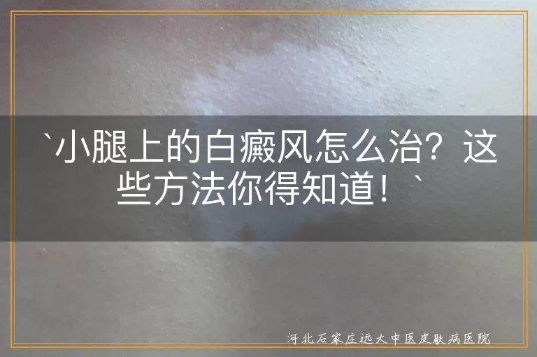 小腿白癜风,治疗方法,药物治疗,光疗,激光治疗,生活习惯调整,防晒,饮食调理,心态调整,中医治疗,中药调理,针灸疗法,拔罐,刮痧,耐心和信心