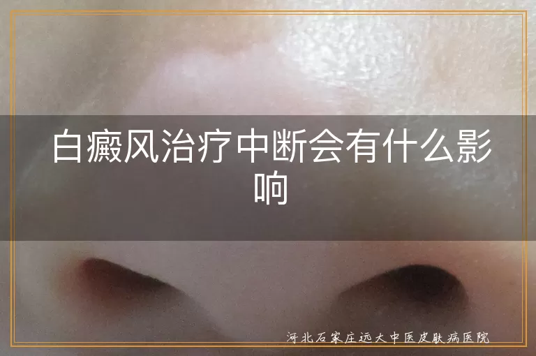 白癜风治疗中断会有什么影响