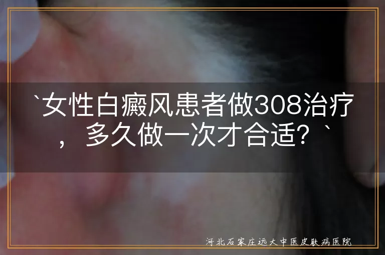女性白癜风患者做308治疗，多久做一次才合适？