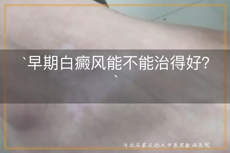 早期白癜风能不能治得好？