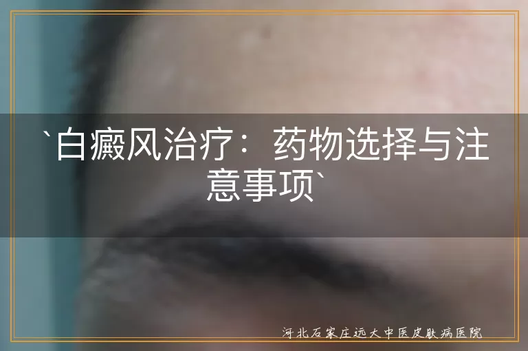白癜风治疗：药物选择与注意事项