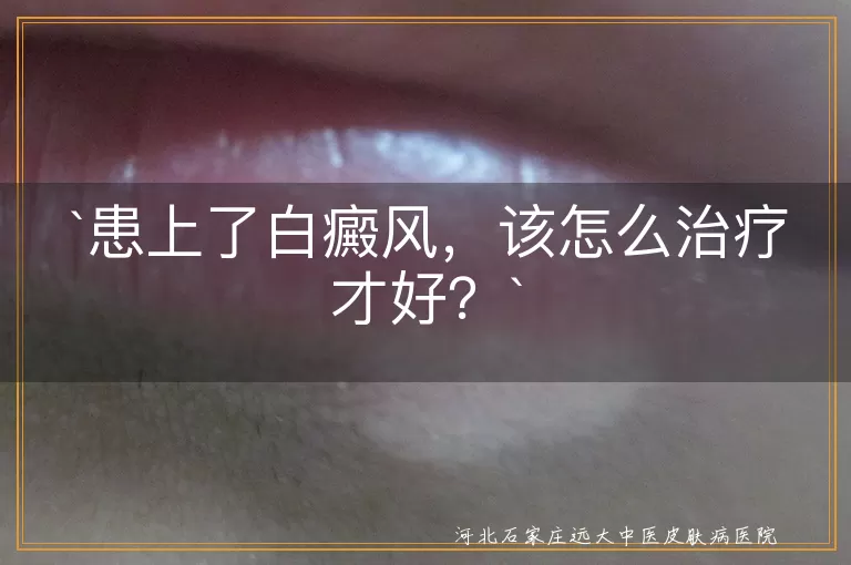 白癜风,治疗,药物,光疗,激光治疗,手术治疗,生活习惯,心态调整,中医调理,心理咨询,饮食调整
