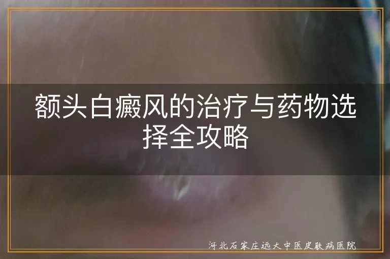 额头白癜风的治疗与药物选择全攻略