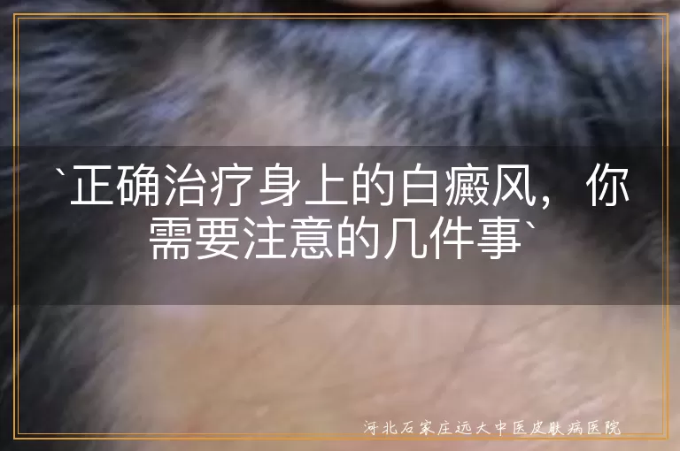 正确治疗身上的白癜风，你需要注意的几件事