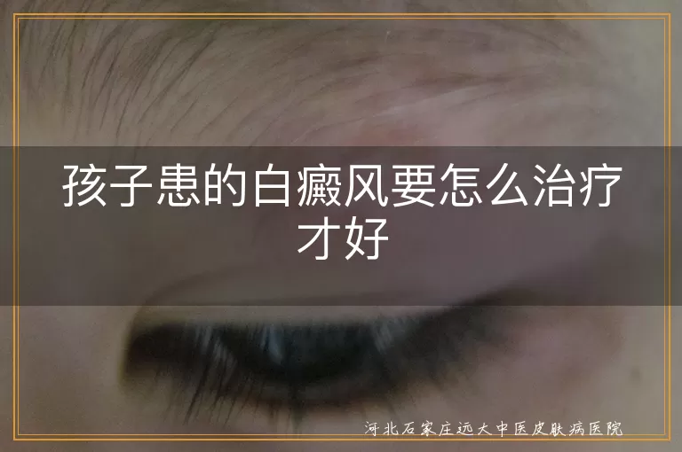 儿童白癜风,治疗,外用药物,口服药物,光疗,预防,日常护理
