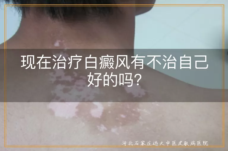 现在治疗白癜风有不治自己好的吗？